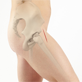 Direct Anterior Hip Replacement