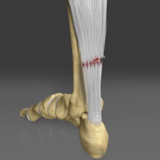 Achilles Tendon Rupture