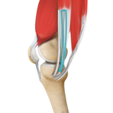 ACL Reconstruction Hamstring Tendon