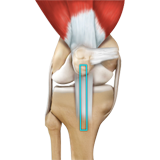 ACL Reconstruction Patellar Tendon