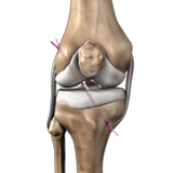 ACL Reconstruction