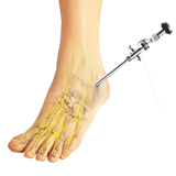 Ankle Arthroscopy