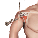 Arthroscopic Rotator Cuff Repair