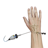 Arthroscopic Wrist Surgery