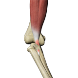 Rupture of the Biceps Tendon