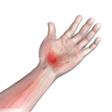 Carpal Tunnel Syndrome