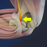 Cubital Tunnel Syndrome