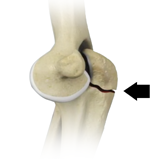 Elbow Fractures