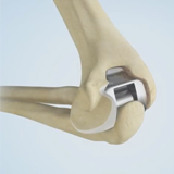 Elbow Joint Replacement