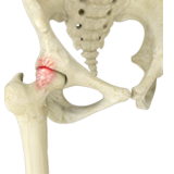 Femoro Acetabular Impingement (FAI)