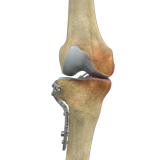 High Tibial Osteotomy