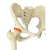 Hip Arthritis