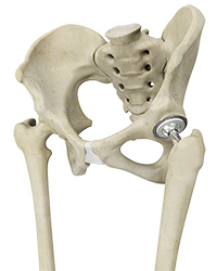 Joint Replacement Surgery