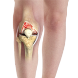 Knee Arthritis