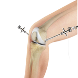 Arthroscopy of the Knee Joint