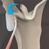 Laterjet Procedure