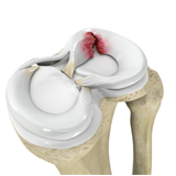 Meniscus Tear