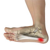 Plantar Fasciitis