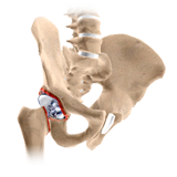 Revision Hip Replacement