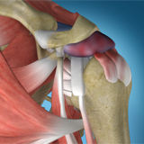 Shoulder Impingement