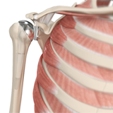 Shoulder Joint Replacement