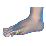 Common Toe Deformities