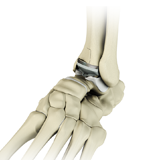 Ankle Joint Replacement