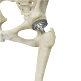 Total Hip Replacement (THR)