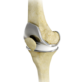 Total Knee Replacement (TKR)