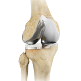 Unicondylar Knee Replacement